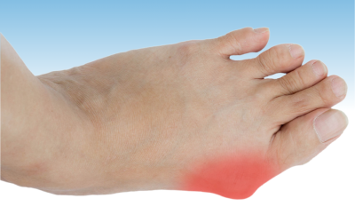 Alluce Valgo: Prevenzione e trattamento